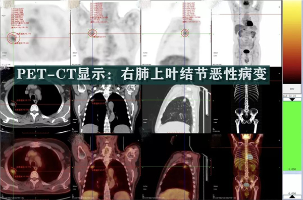 入院后在常规ct检查中发现患者存在肺部占位的情况,疑似患有肺部肿瘤